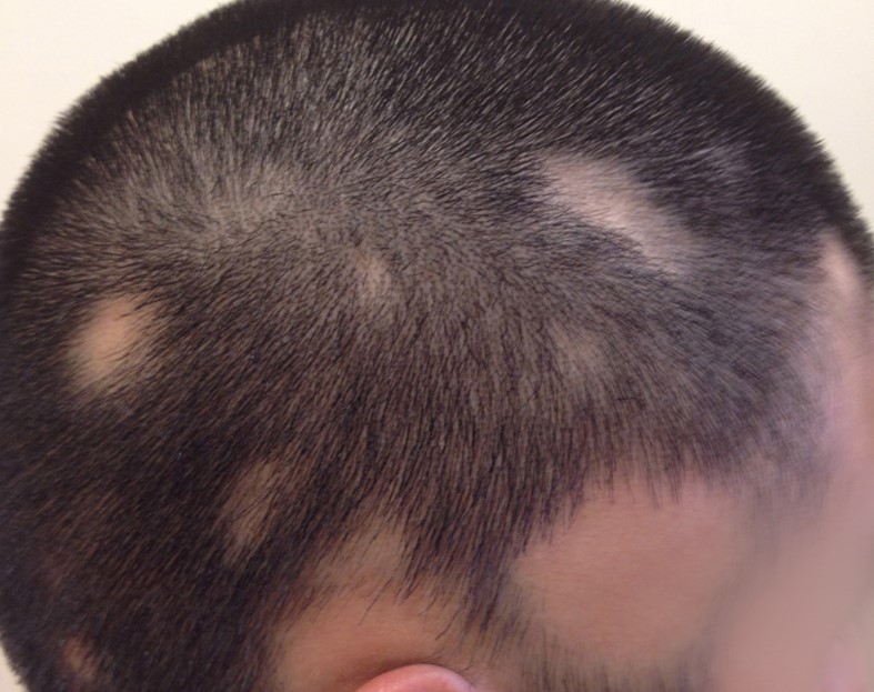 Alopecia areata