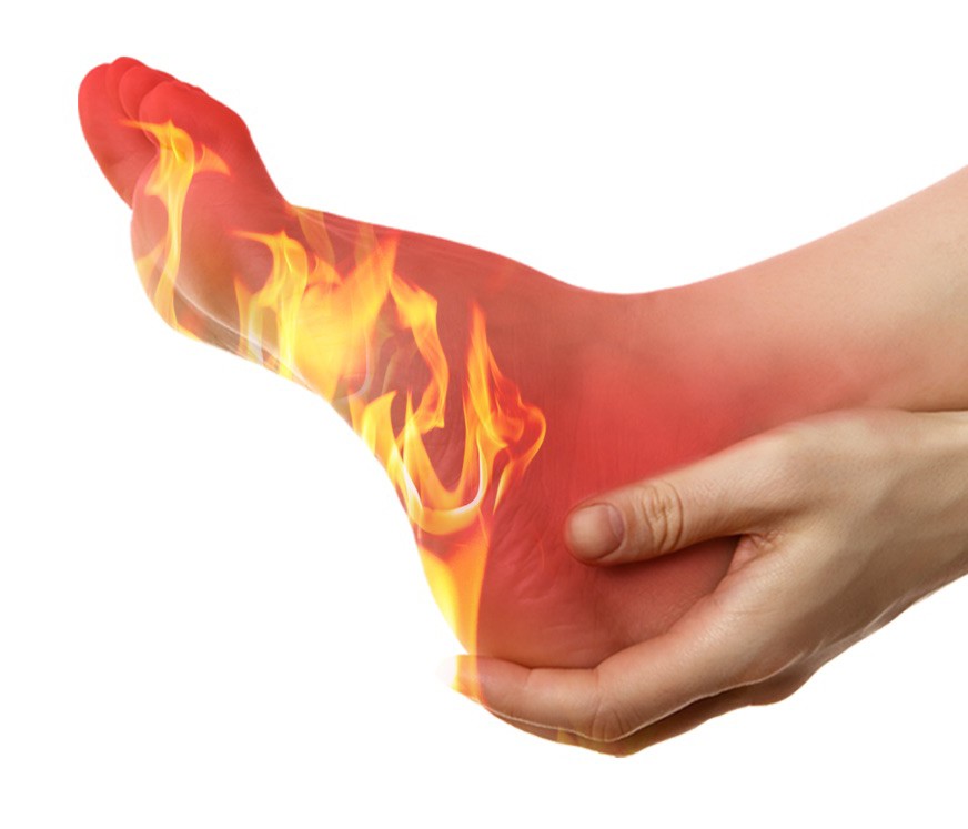 Burning Feet Syndrome