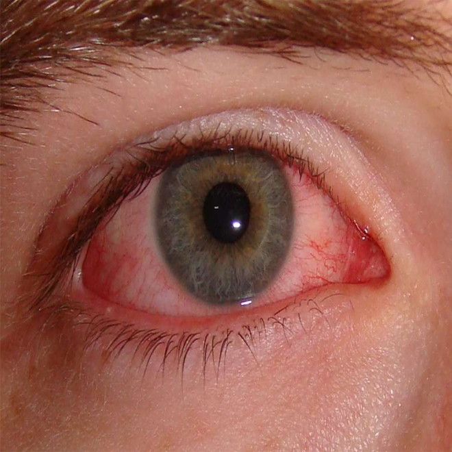 Conjunctivitis/Eye redness