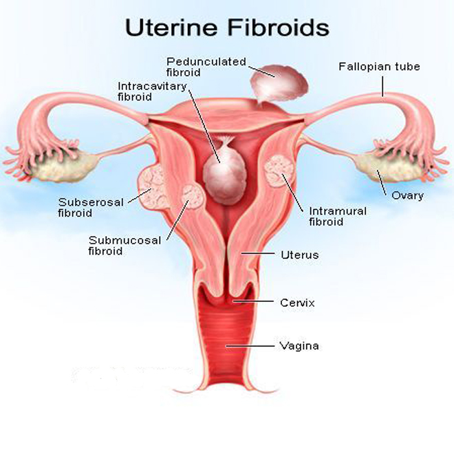 Fibroid Uterus