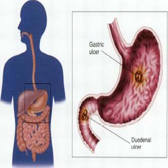 Gastric ulcer