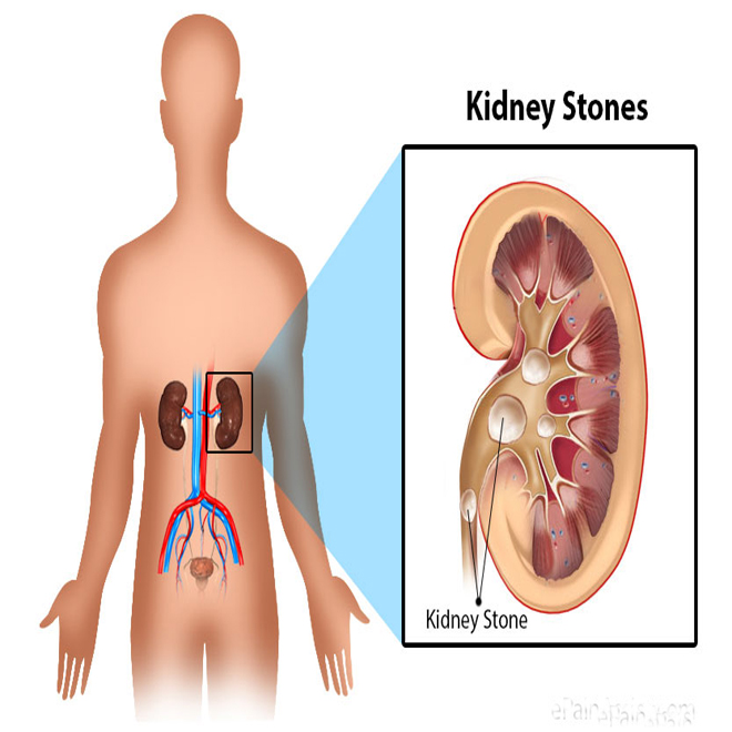 Kidney Stone And Renal caliculi