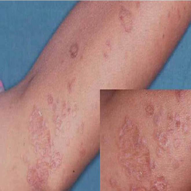 Lichen Planus