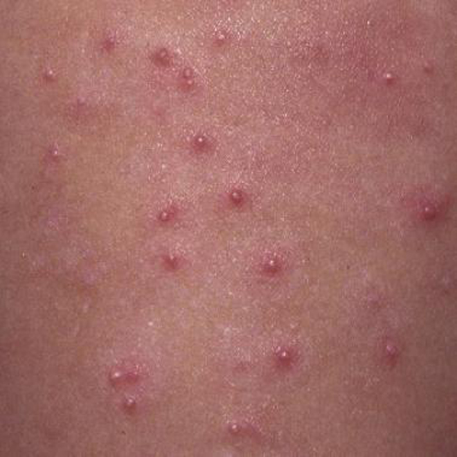 Molluscum contagiosum