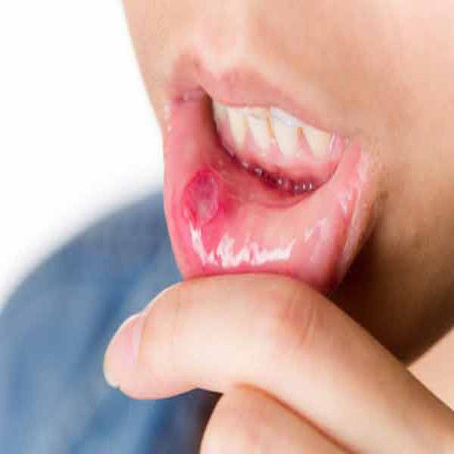 Mouth Ulcer