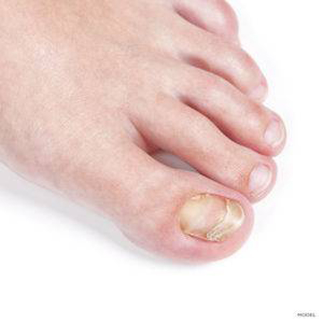 Nail Fungus