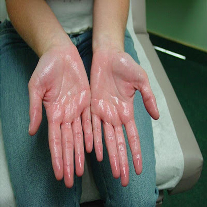 Sweaty palms and soles