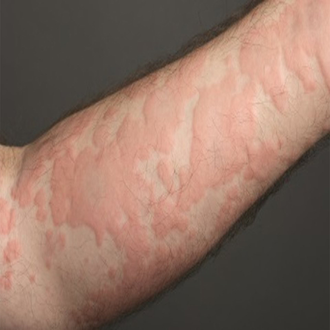 Urticaria